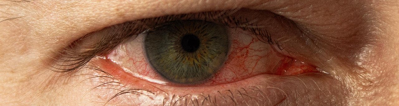 Olhos inchados: o que pode causar e quando procurar um especialista